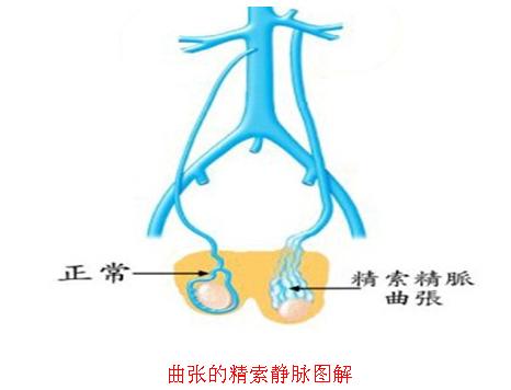 精索靜脈曲張怎么治療